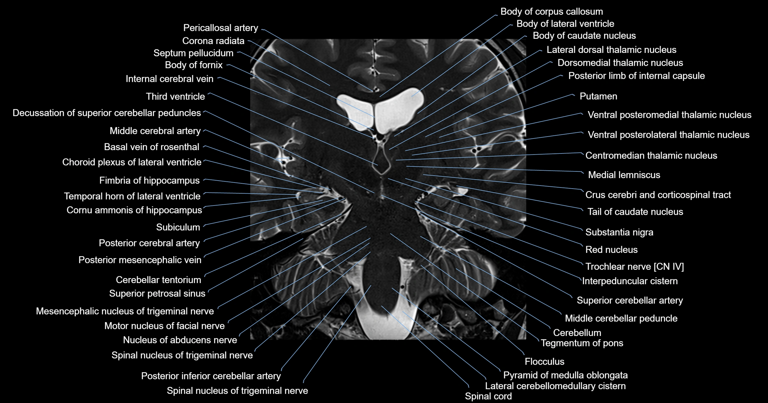 MRI brainstem & basal ganglia anatomy labelled 3T MRI images -img-00001-00023.webp